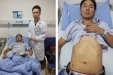 我院外科成功开展腹腔镜胃、十二指肠溃疡修补术